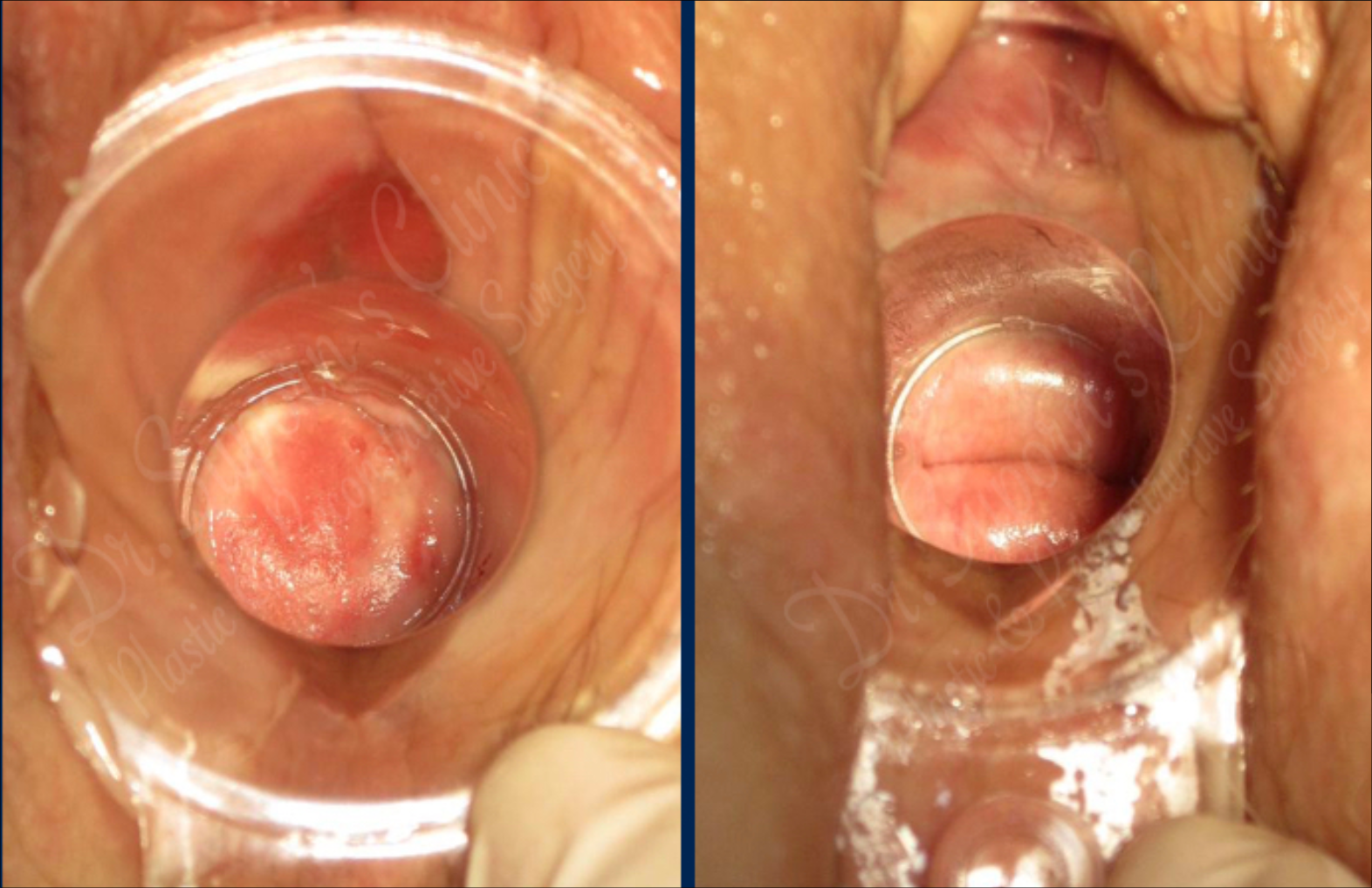 Neovagina seen through a speculum. Clearly mucosal