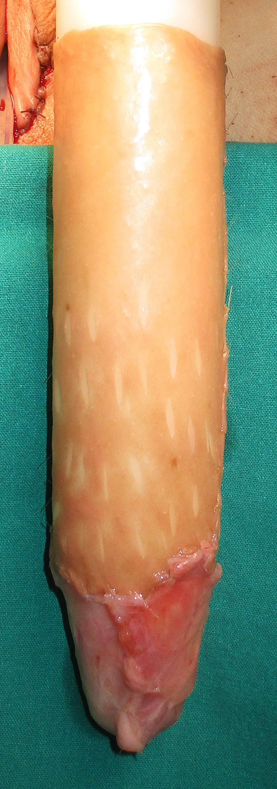 Neovagina before implantation